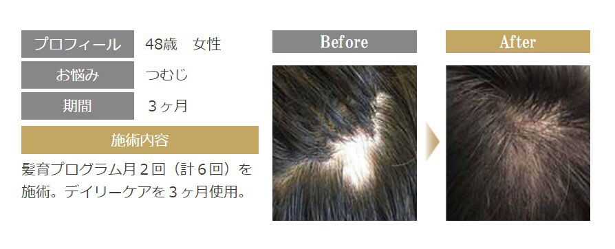 ACTIVART［アクティバート］髪育プラグラムで女性の薄毛・抜け毛を改善